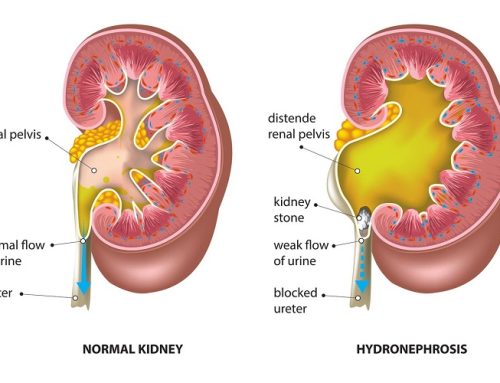 Antenatal Hydronephrosis